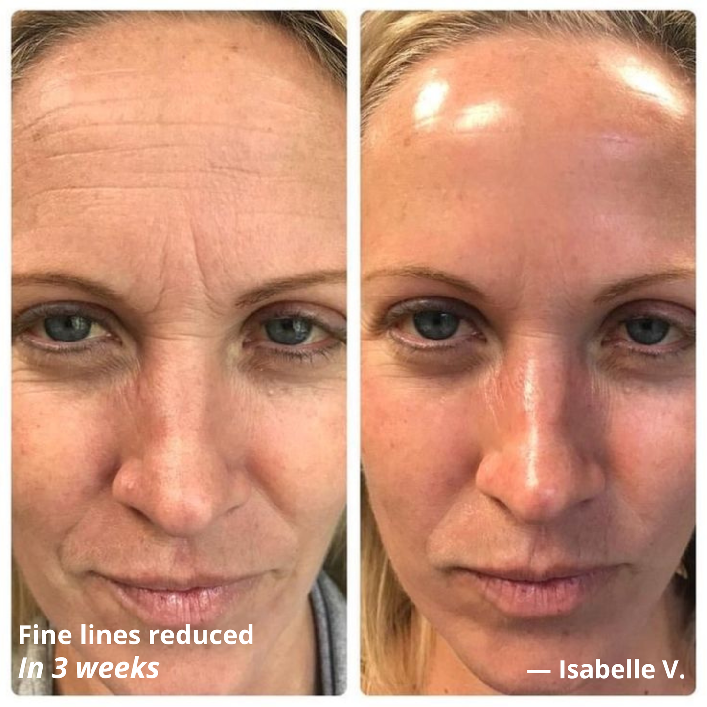 Glass Skin Lifting Device